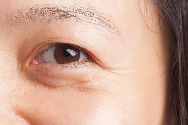 dấu hiệu lão hóa da mắt
